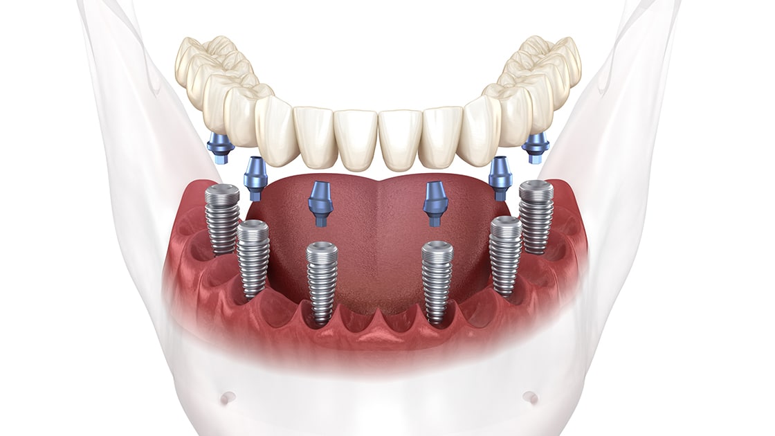 Implant Supported Dentures Graphic